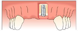 Anterior Tooth Replacement with Dental Implants