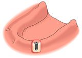 Full Lower Dental Implant Treatment