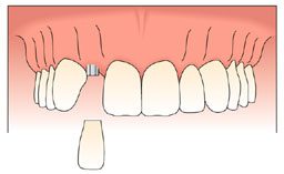 single tooth implant