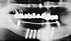 Xray