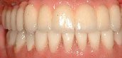 Teeth In A Day