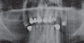 Panorex Xray