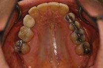 Teeth In A Day