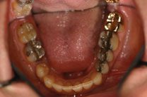Teeth In A Day