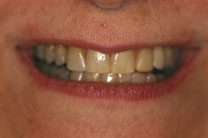 Teeth In A Day