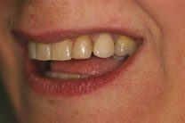 Teeth In A Day
