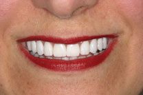 Teeth In A Day
