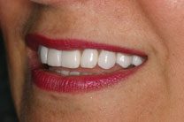 Teeth In A Day