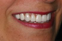 Teeth In A Day