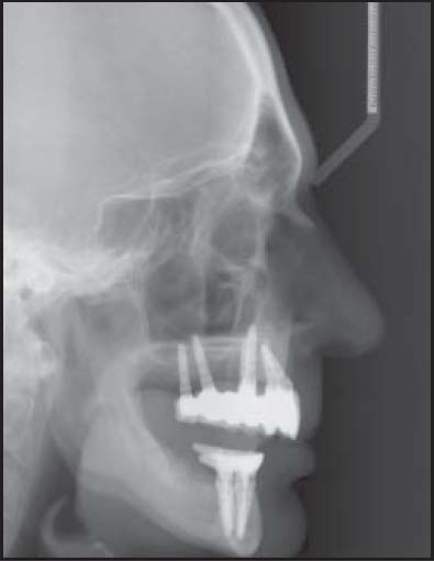Post op lateral cephalometric xray