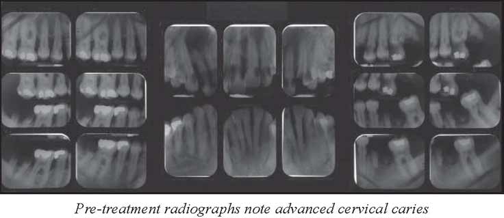 Full Mouth Xray