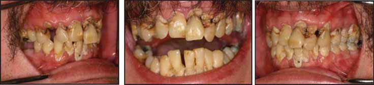 Pretreatment teeth