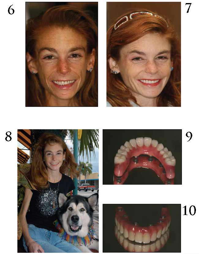 Dental Implant Treatment Photos