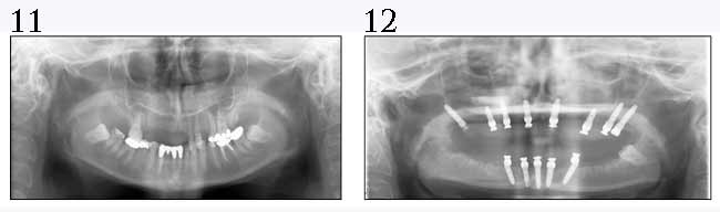 Panoramic Radiographs