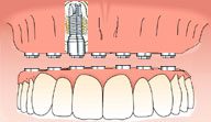 Oral Rehabilitation