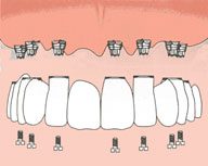 Oral Rehabilitation