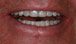 Postop Teeth