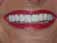 Postop closeup