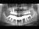 Postop xray