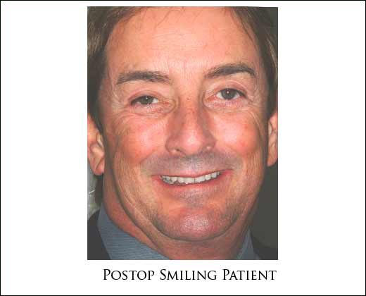 Preop full face
