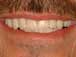 Postop closeup