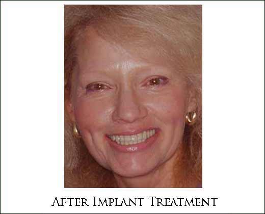 Preop full face