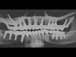 Postop xray