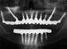 Postop xray