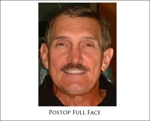 Postop face