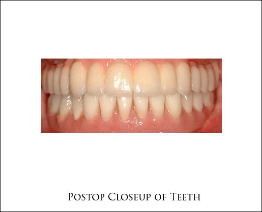 Postop closeup