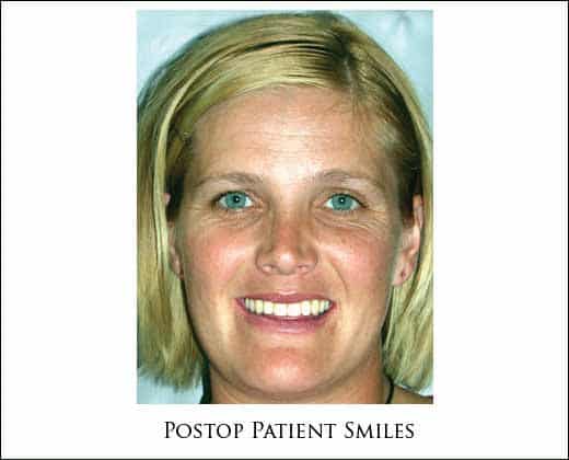 Preop full face