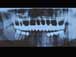 Postop xray