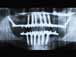 Postop xray