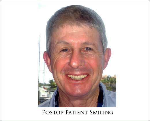 Preop full face