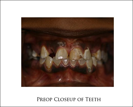 Preop closeup