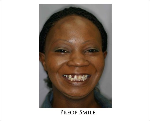 Preop face