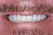 Post Treatment Smile