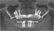 Postop xray