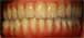 Postop Teeth