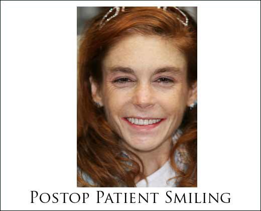 Preop full face