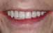 Postop closeup