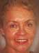 Dental implant treatment in patient with alveolar bone loss