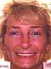  Esthetic Reconstruction Using Procera All Ceramic Crowns