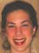 Patient with Ectodermal Dysplasia - Dental Implant Restoration