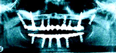 Postop xray1