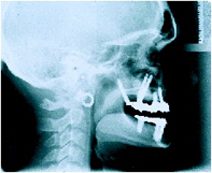 Postop Xray1