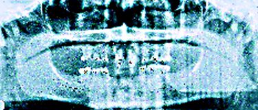 Postop Xray