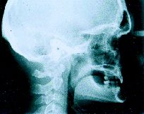 Preop xray