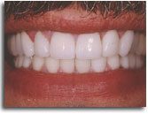 All-Ceramic Crown Treatment