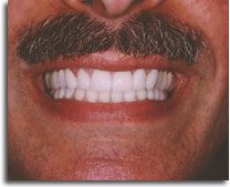 All-Ceramic Crown Treatment